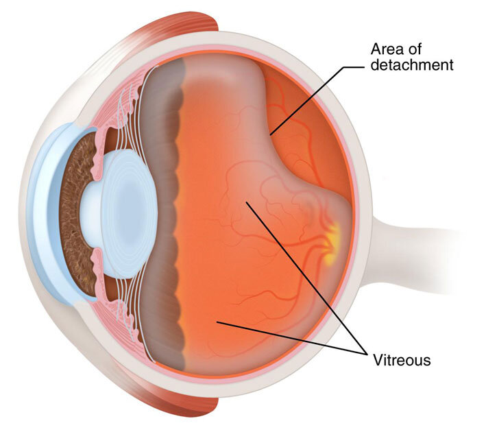 Diagram showing the vitreous gel filling the inside of the eye