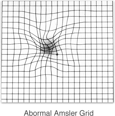 Amsler Grid - Retina-Vitreous Surgeons of CNY