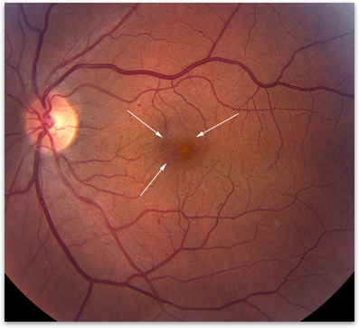 retina edema causes)