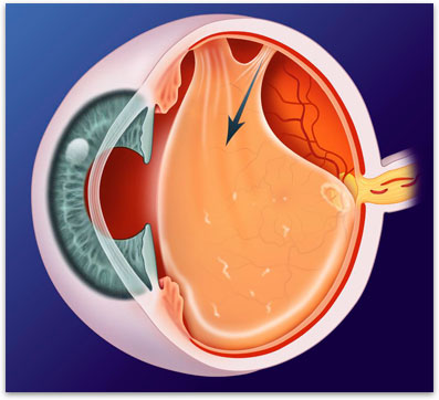 Flashes And Floaters Retina Vitreous