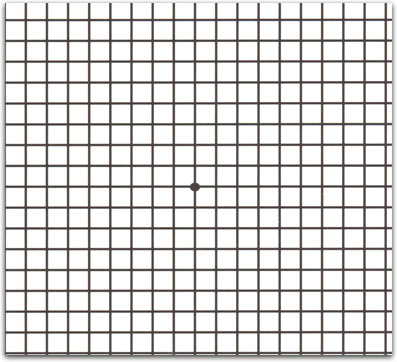 An Amsler grid showing mild distortion.