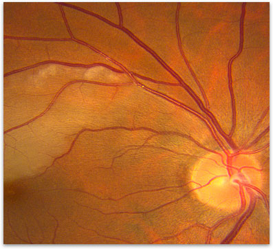 central retinal artery occlusion vs normal