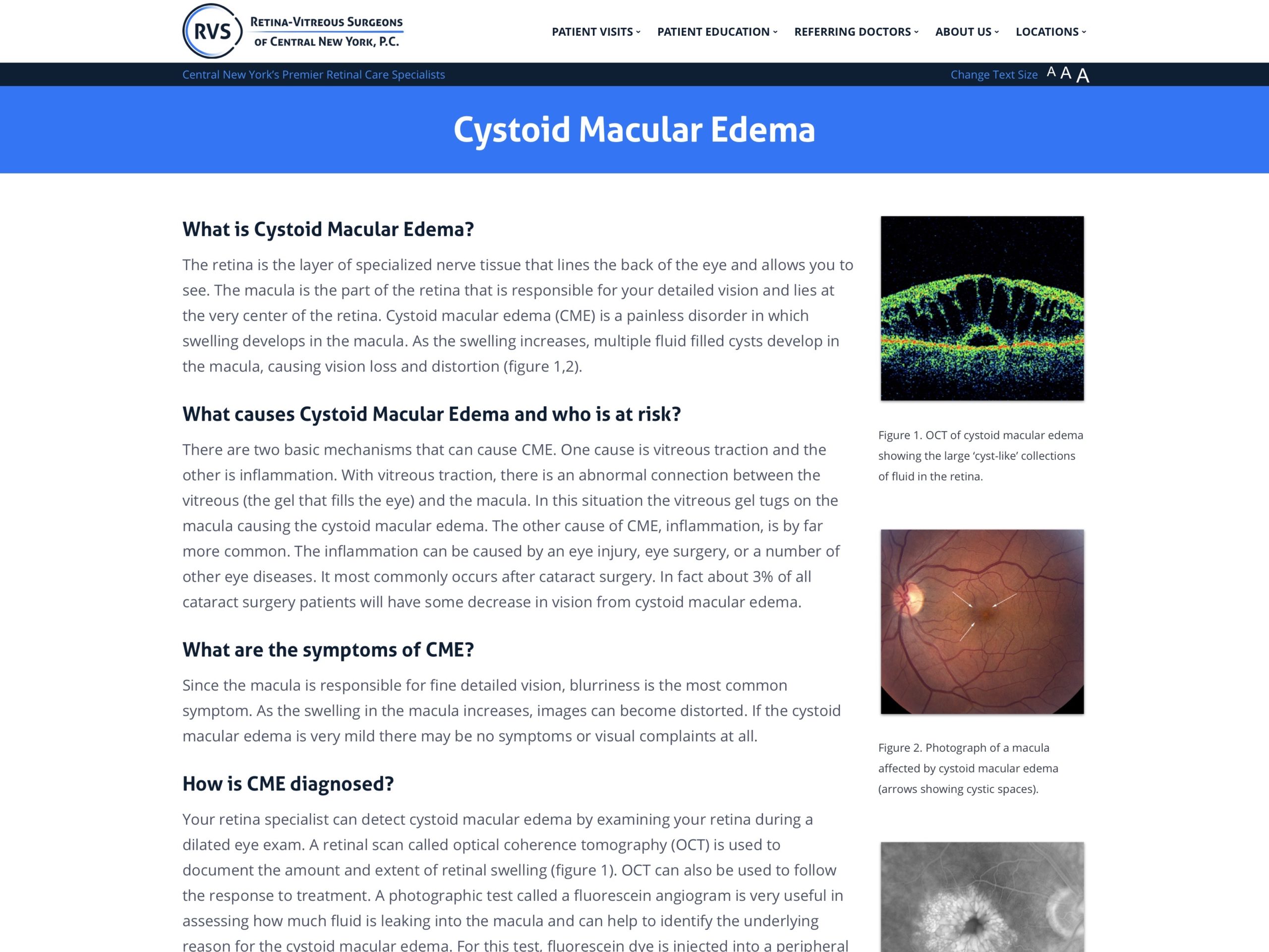 retinal edema causes