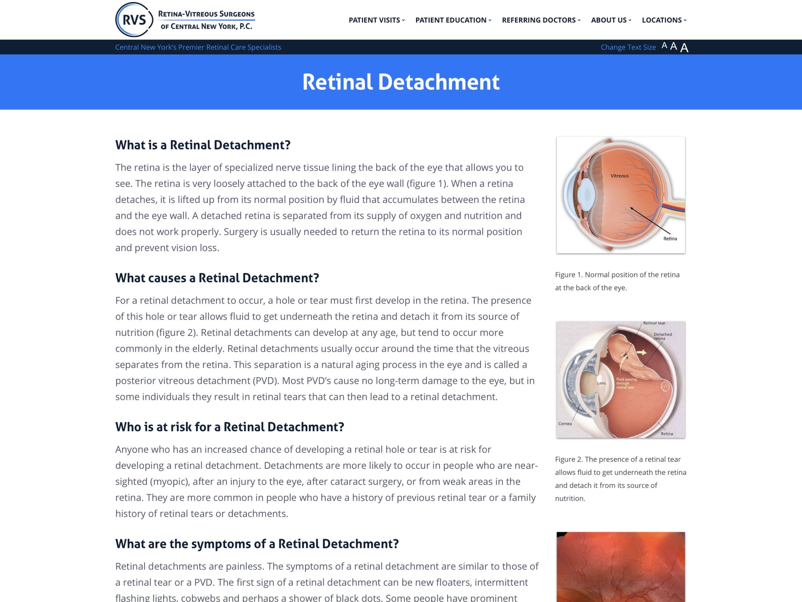 Retinal Detachment - Vitreo-Retinal Consultants